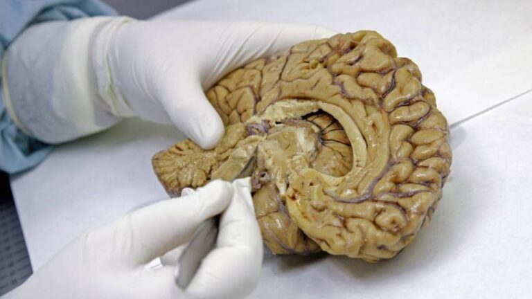 Descubrimiento de la Red Cerebral Somato-Cognitiva (SCAN) Abre Nuevas Vías para el Tratamiento del Párkinson: Estudio Detallado en ‘Nature’